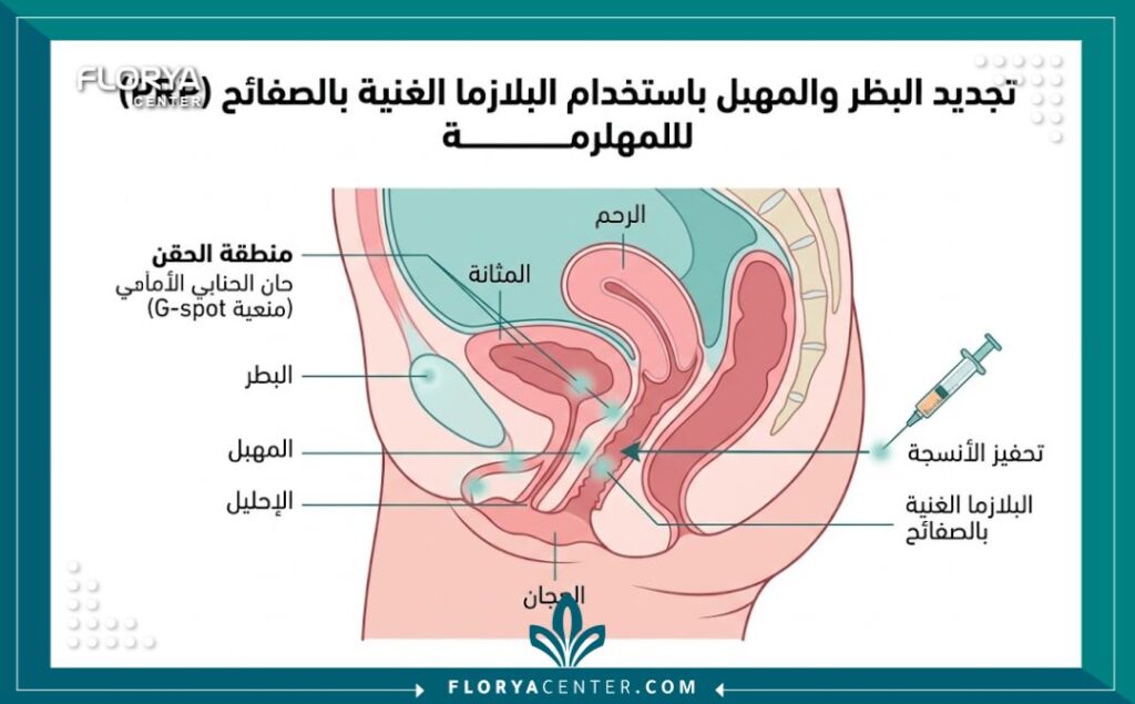مخطط طبي تشريحي يوضح آلية عمل حقن O-Shot وأماكن حقن البلازما لتحفيز الأنسجة المهبلية.