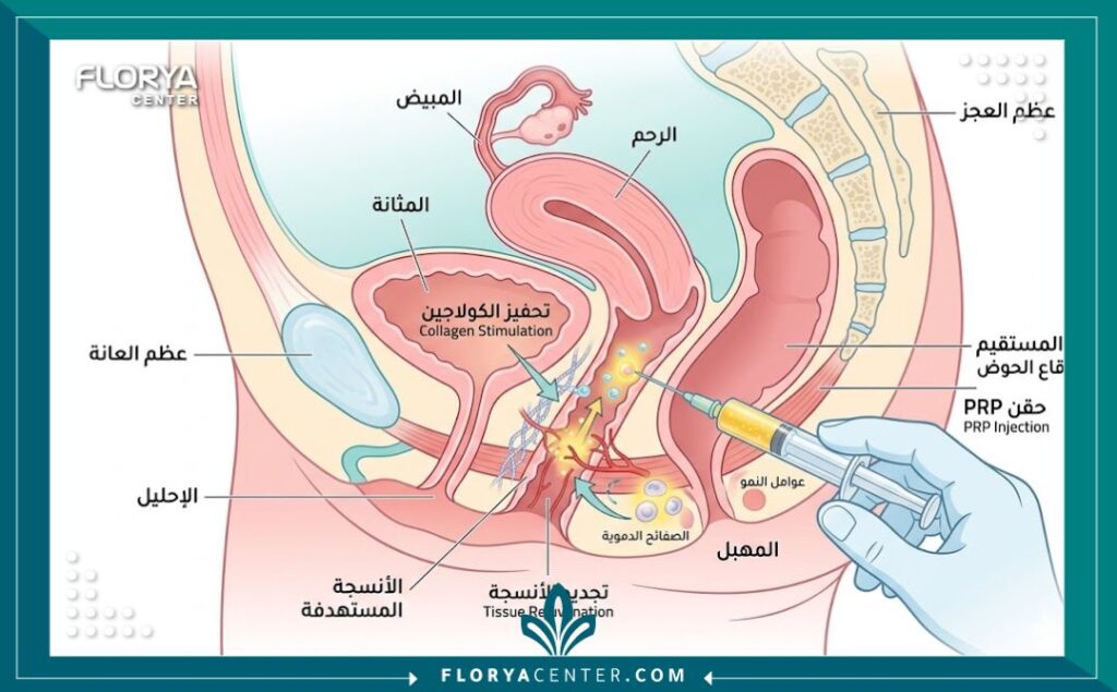 رسم تخطيطي طبي يوضح آلية عمل حقن البلازما في تجديد أنسجة المنطقة الحساسة لدى النساء.