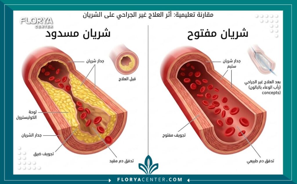 مخطط طبي يوضح الفرق بين الشريان المسدود والشريان السليم بعد العلاج غير الجراحي.