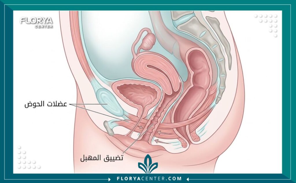 رسم توضيحي طبي يشرح تشريح عضلات الحوض وعملية تضييق المهبل.