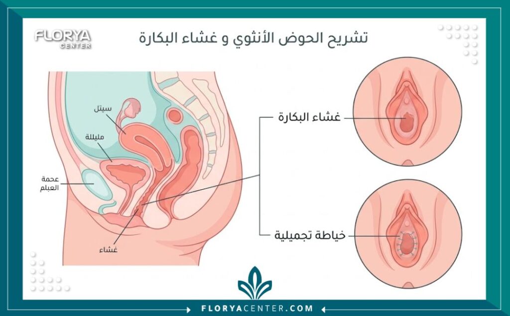 رسم توضيحي طبي يشرح كيفية إجراء خياطة غشاء البكارة التجميلية.
