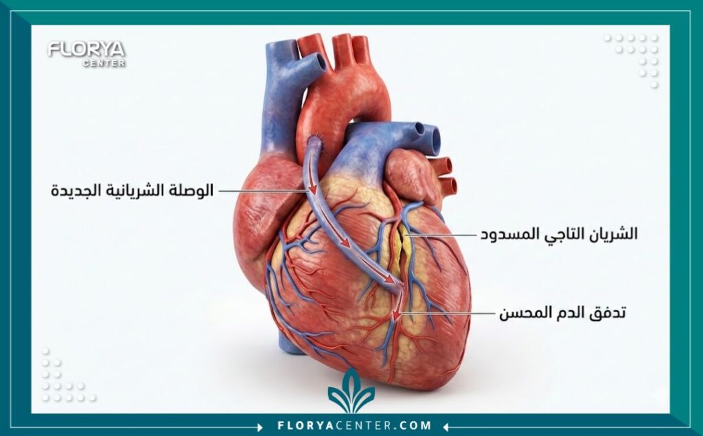 مخطط طبي ثلاثي الأبعاد يوضح عملية زراعة مجازة الشريان التاجي (تغيير شرايين القلب) مع تسميات باللغة العربية.