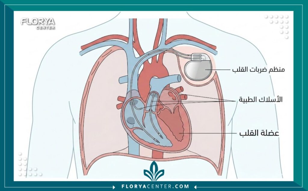 رسم توضيحي طبي يوضح مكان تركيب بطارية القلب داخل الصدر وكيفية اتصالها بالقلب مع تسميات بالعربية.
