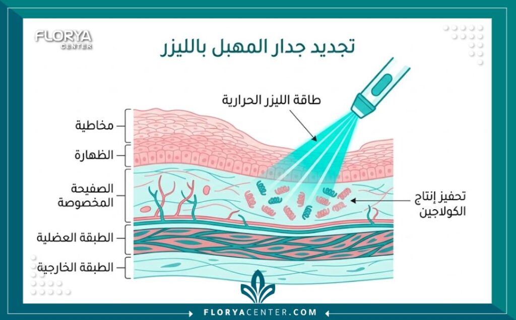 رسم توضيحي طبي يشرح آلية عمل الليزر في تحفيز الكولاجين وتضييق جدران المهبل.