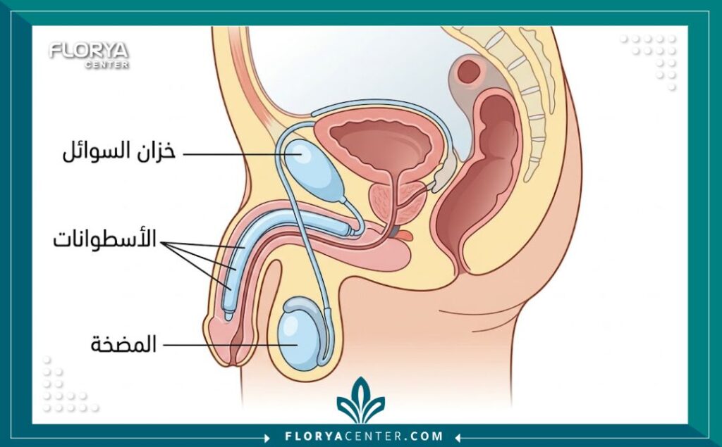 رسم تخطيطي طبي يوضح أماكن تركيب أجزاء الدعامة الثلاثية داخل الجسم.