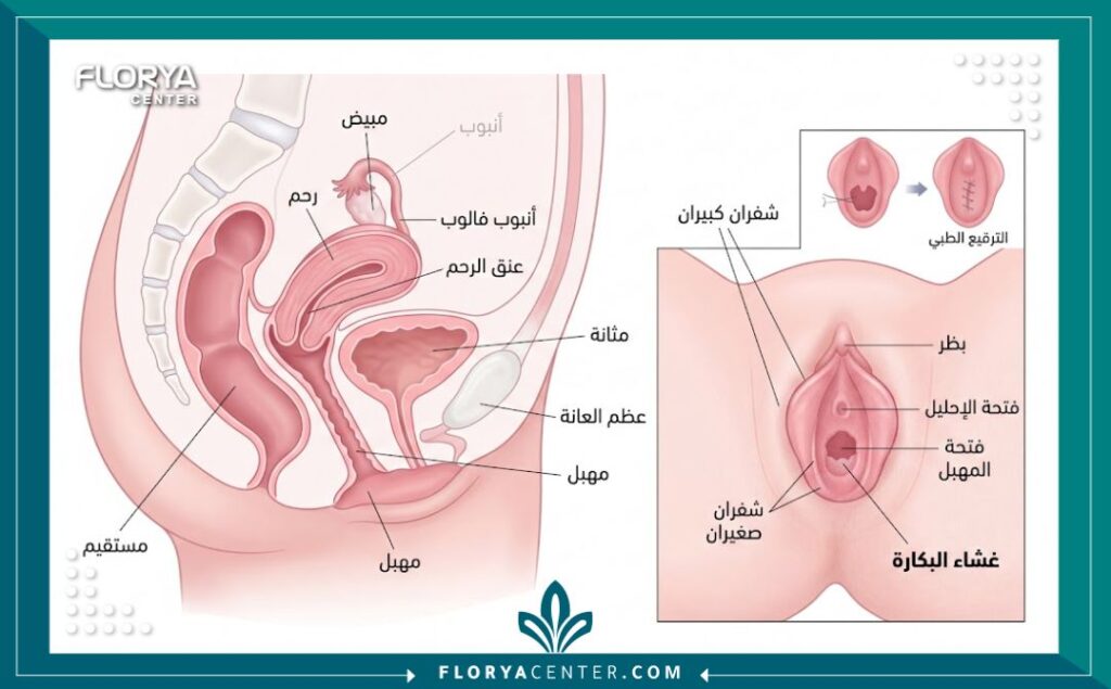 رسم توضيحي طبي يشرح آلية عملية ترقيع الغشاء والتشريح الدقيق للمنطقة.
