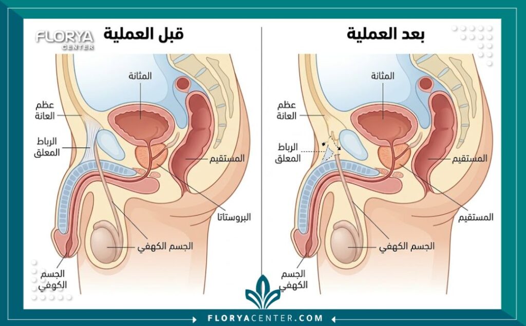 مخطط طبي يوضح التشريح الداخلي وطريقة إجراء عملية تطويل القضيب عن طريق قطع الرباط المعلق.