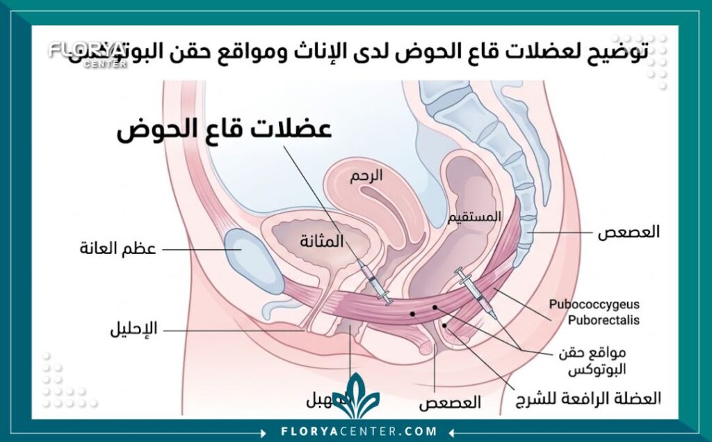 رسم تخطيطي طبي يوضح تشريح عضلات الحوض ومناطق حقن البوتكس لعلاج التشنج.