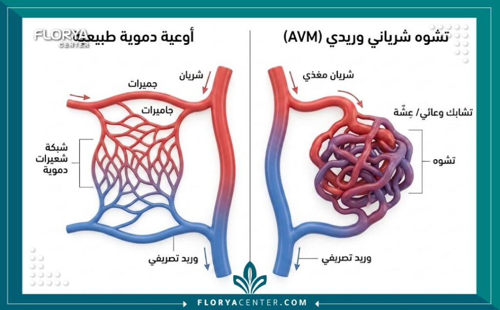 رسم تخطيطي طبي يوضح الفرق بين الأوعية الدموية الطبيعية وتشابك الأوعية في التشوهات الوعائية الشريانية الوريدية.