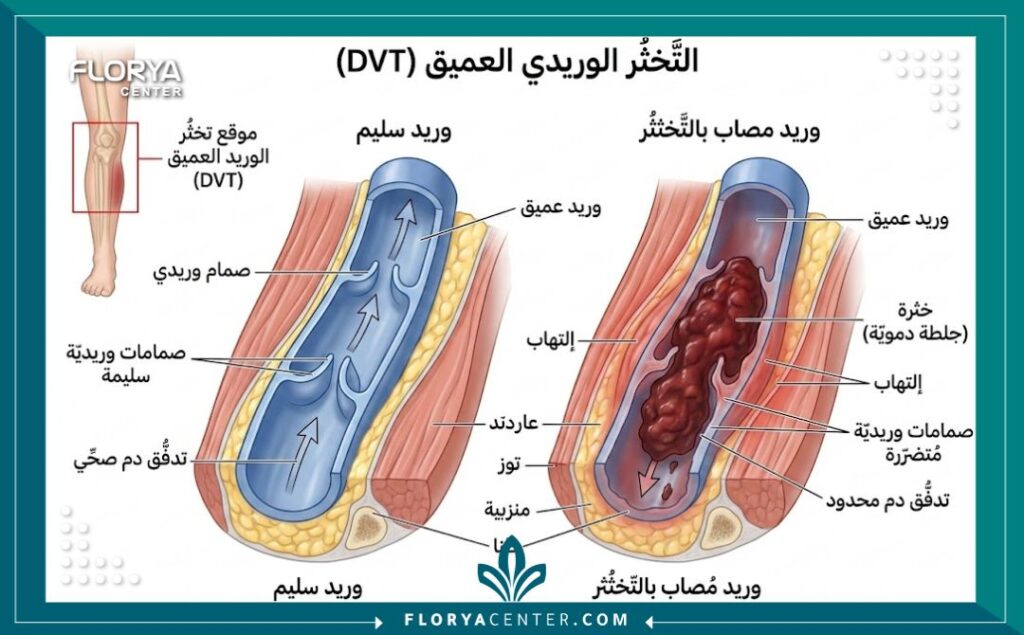 رسم تخطيطي طبي يوضح جلطة وريدية عميقة في ساق الإنسان مع تسميات باللغة العربية