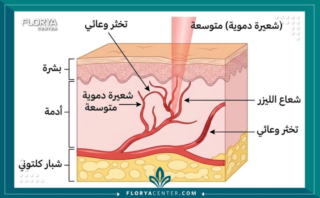 مخطط توضيحي طبي يُظهر آلية علاج الشعيرات الدموية بالليزر، حيث يستهدف شعاع الليزر الشعيرة الدموية المتوسعة لإحداث تخثر وعائي دون الإضرار بالبشرة والأدمة.