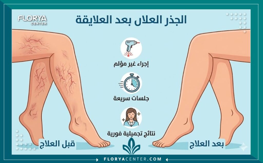 إنفوجرافيك يُظهر مقارنة قبل وبعد علاج الشعيرات الدموية بالليزر على الساق، مع توضيح الفوائد مثل "إجراء غير مؤلم" و"نتائج تجميلية فورية".