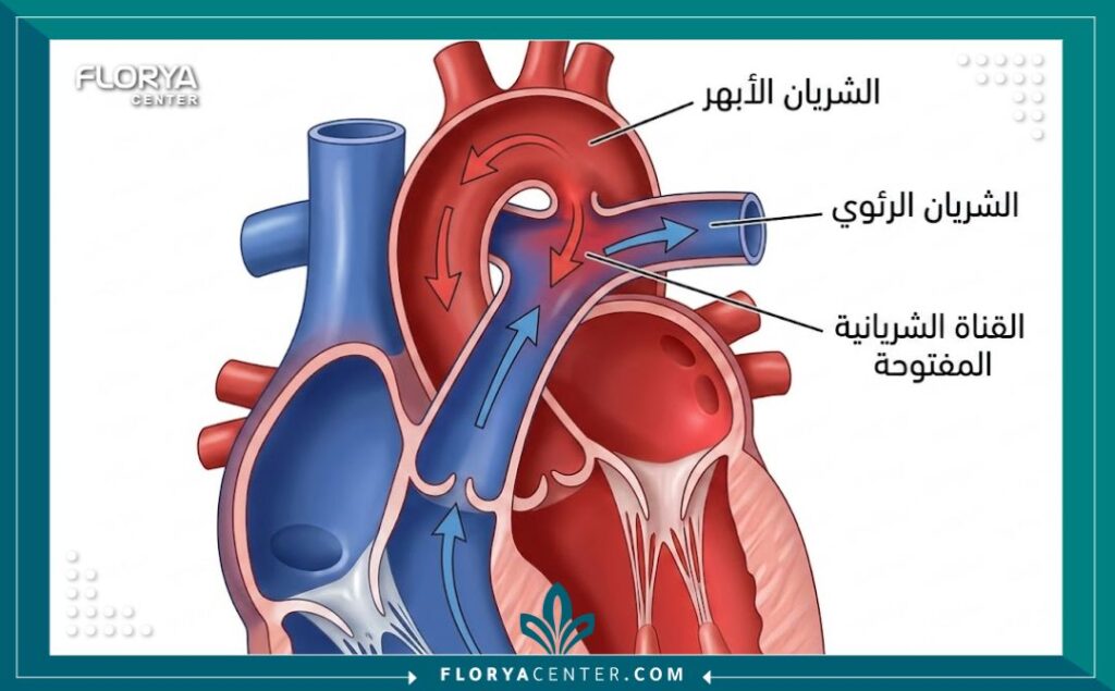 علاج القناة الشريانية السالكة 2 رسم تخطيطي طبي يوضح موقع القناة الشريانية السالكة والاتصال بين الأبهر والشريان الرئوي.