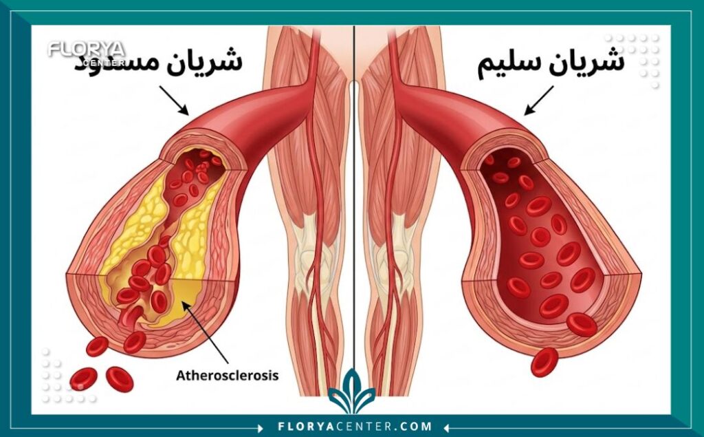 رسم توضيحي طبي يقارن بين الشريان المسدود بالدهون والشريان السليم في الساق.