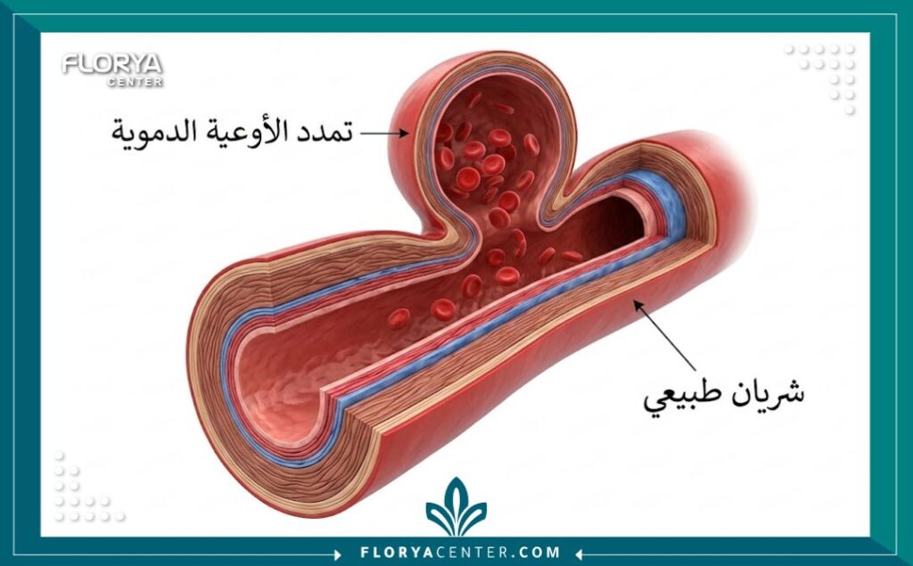 مخطط طبي تشريحي يوضح الفرق بين الشريان الطبيعي وتمدد الأوعية الدموية في الدماغ مع تسميات بالعربية.