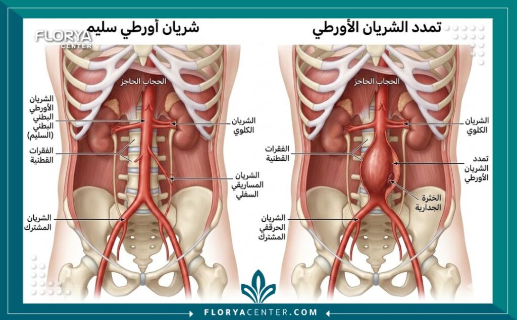رسم تخطيطي طبي يوضح الفرق بين الشريان الأورطي السليم وتمدد الشريان الأورطي البطني.