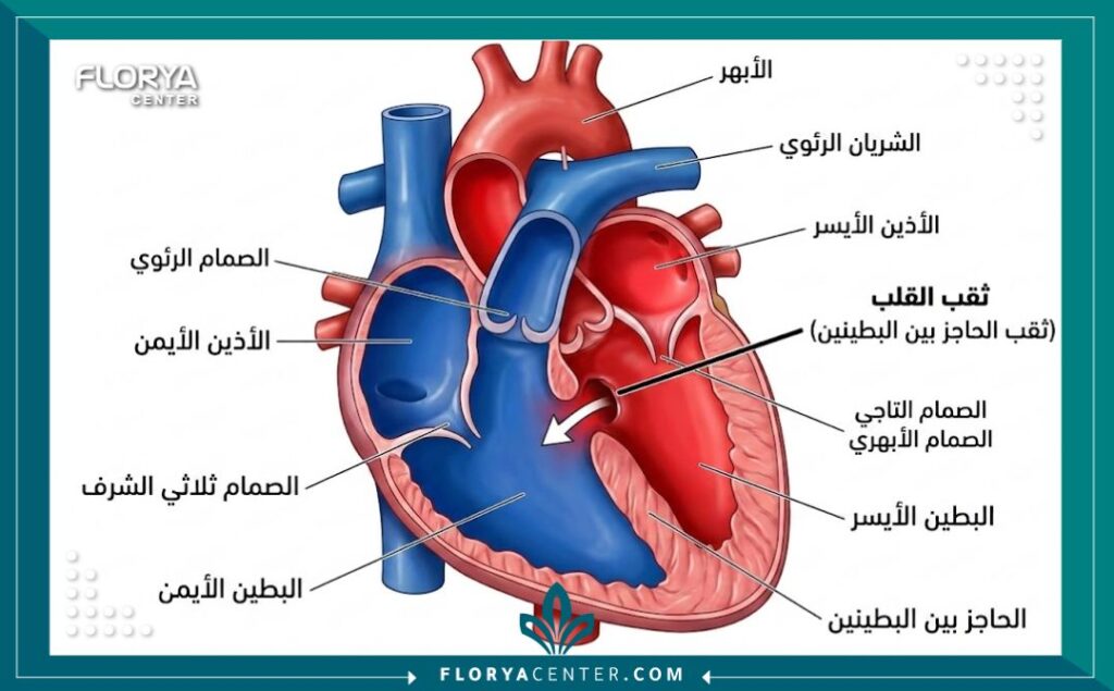 رسم توضيحي طبي دقيق يشرح تشريح ثقب القلب عند الرضع وموقع الفتحة بين البطينين.