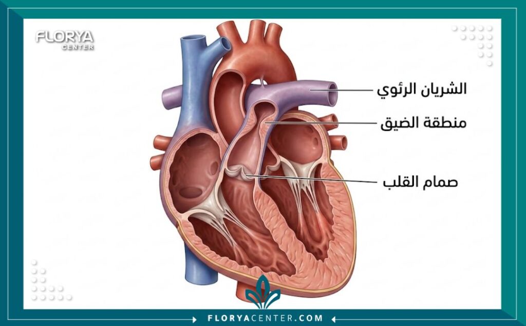 رسم توضيحي طبي ثلاثي الأبعاد يوضح تشريح القلب وموقع ضيق الشريان الرئوي عند الأطفال.