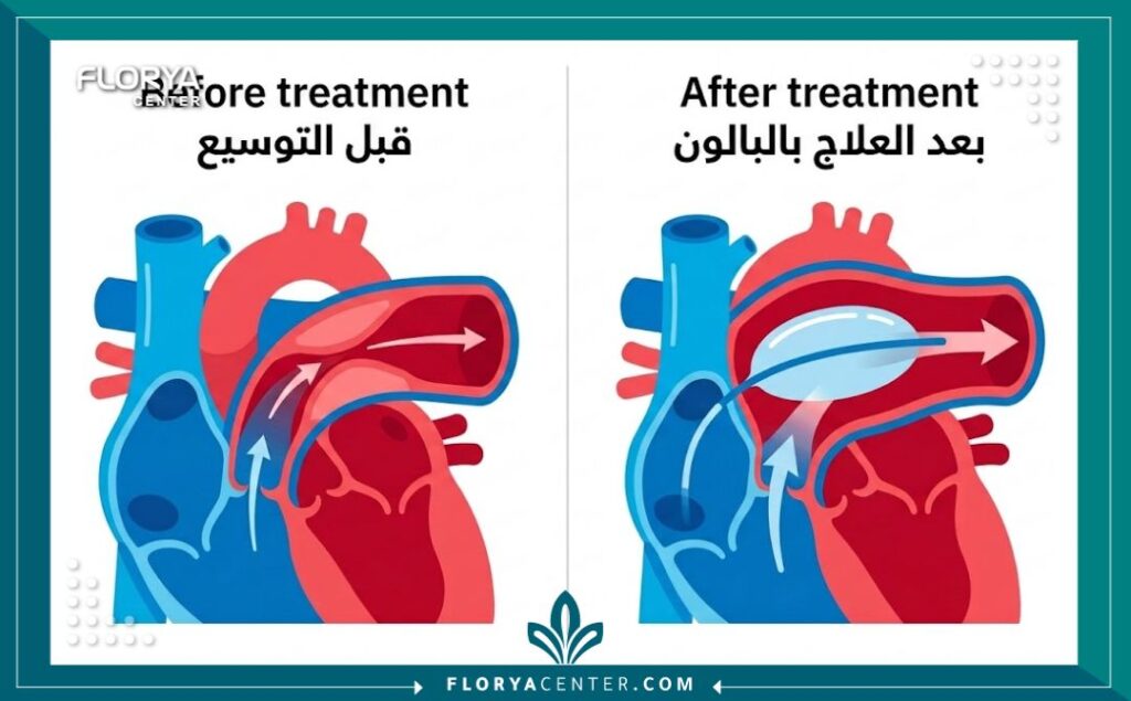 إنفوجرافيك طبي يقارن بين الشريان الرئوي الضيق والشريان بعد علاج ضيق الشريان الرئوي للأطفال.