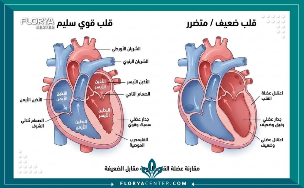 رسم تخطيطي طبي يوضح الفرق بين عضلة القلب السليمة وعضلة القلب الضعيفة.