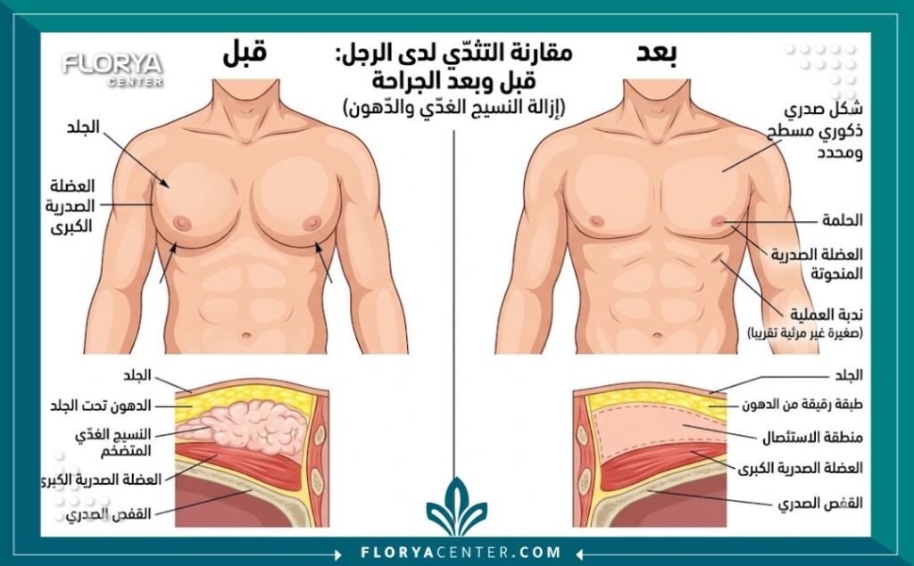 عمليات التجميل الذكورية 1 - عمليات التجميل الذكورية تؤثر الثقة بالنفس بشكل مباشر على نجاح الرجل المهني والاجتماعي اليوم. لذا تعيد عمليات التجميل الذكورية (Male Plastic Surgery) صياغة مفهوم الوسامة عبر حلول طبية دقيقة تتجاوز التوقعات التقليدية، حيث يمثل مركز فلوريا المعيار الذهبي للجودة.