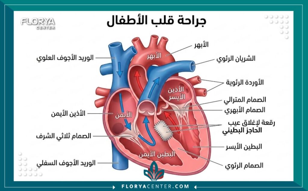 مخطط طبي تشريحي يوضح تفاصيل عملية إصلاح عيوب القلب الخلقية للأطفال في تركيا.