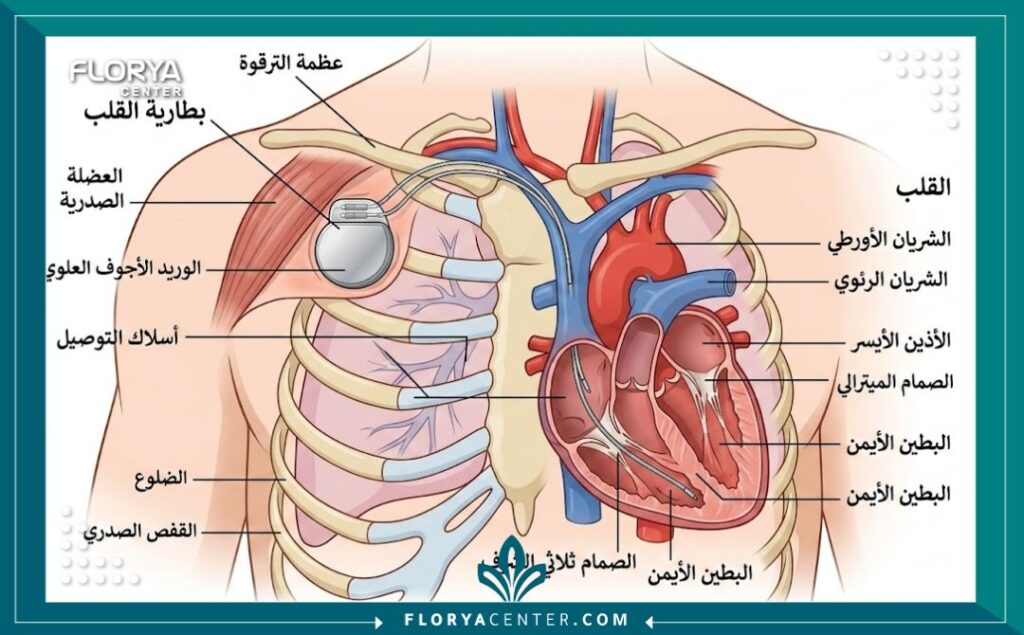 مخطط طبي يوضح موقع بطارية القلب وطريقة توصيل الأسلاك بالبطين والأذين.