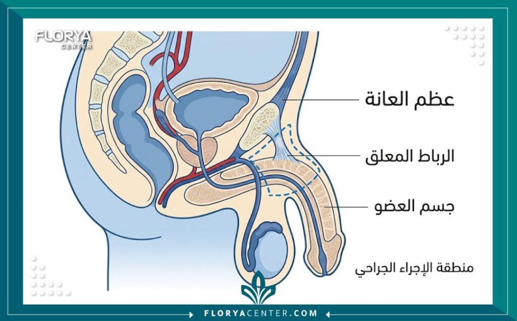 رسم تخطيطي طبي يوضح تشريح العضو الذكري والرباط المعلق المستخدم في جراحة التطويل، مع تسميات عربية.