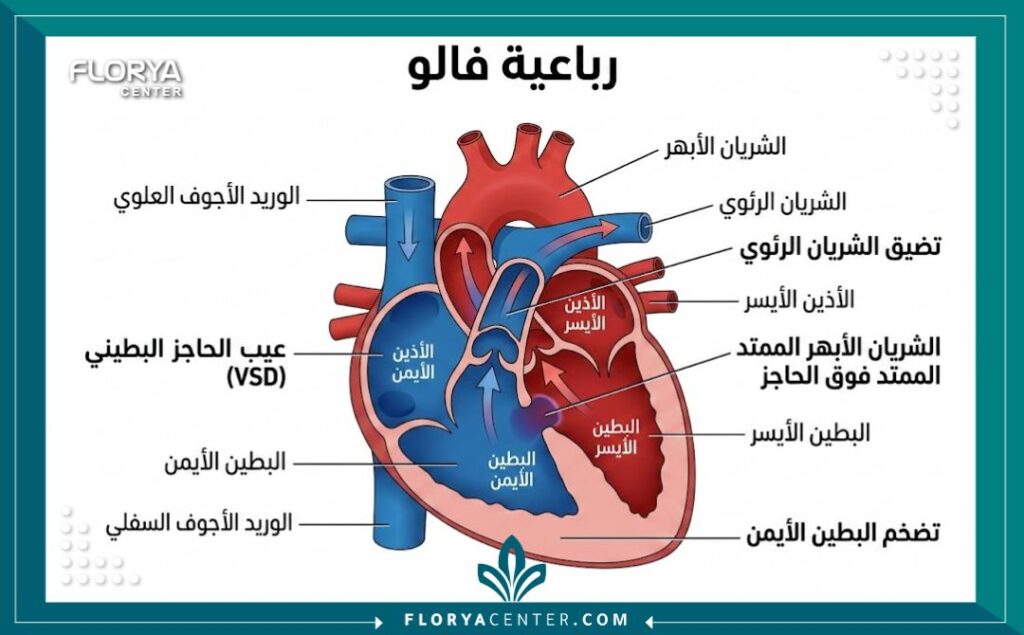 مخطط تشريحي يوضح العيوب الأربعة في متلازمة رباعية فالوت باللغة العربية.