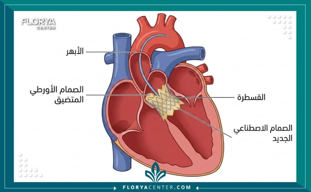 رسم تخطيطي طبي يوضح خطوات عملية زراعة الصمام الأورطي بالقسطرة (TAVI)
