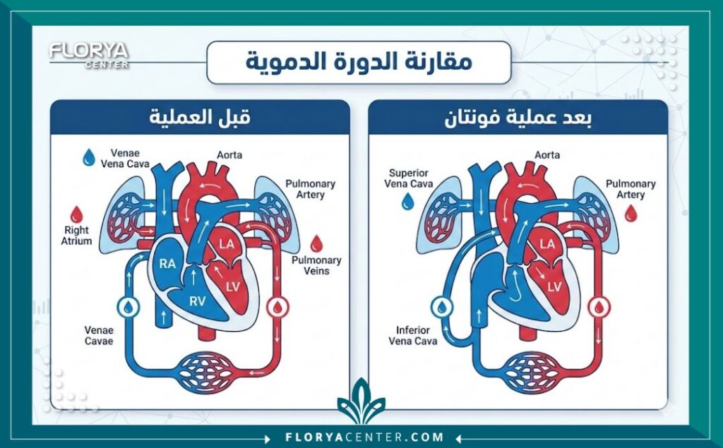 إنفوجرافيك طبي يقارن بين الدورة الدموية الطبيعية والدورة الدموية بعد عملية فونتان.