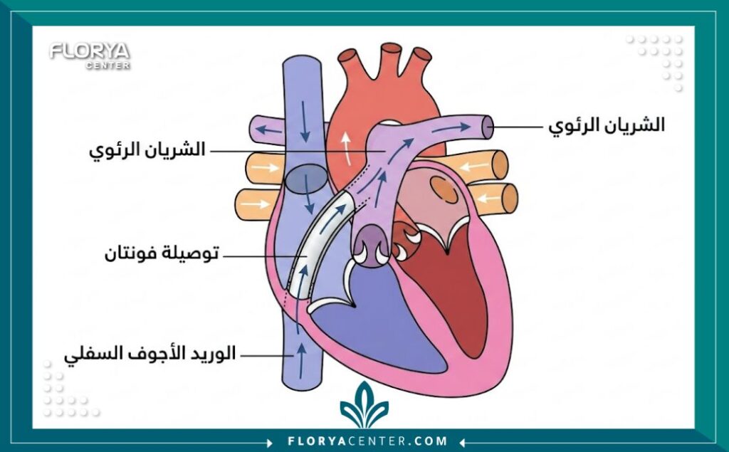 مخطط تشريحي لعملية فونتان يوضح كيفية توصيل الوريد الأجوف السفلي بالشريان الرئوي.