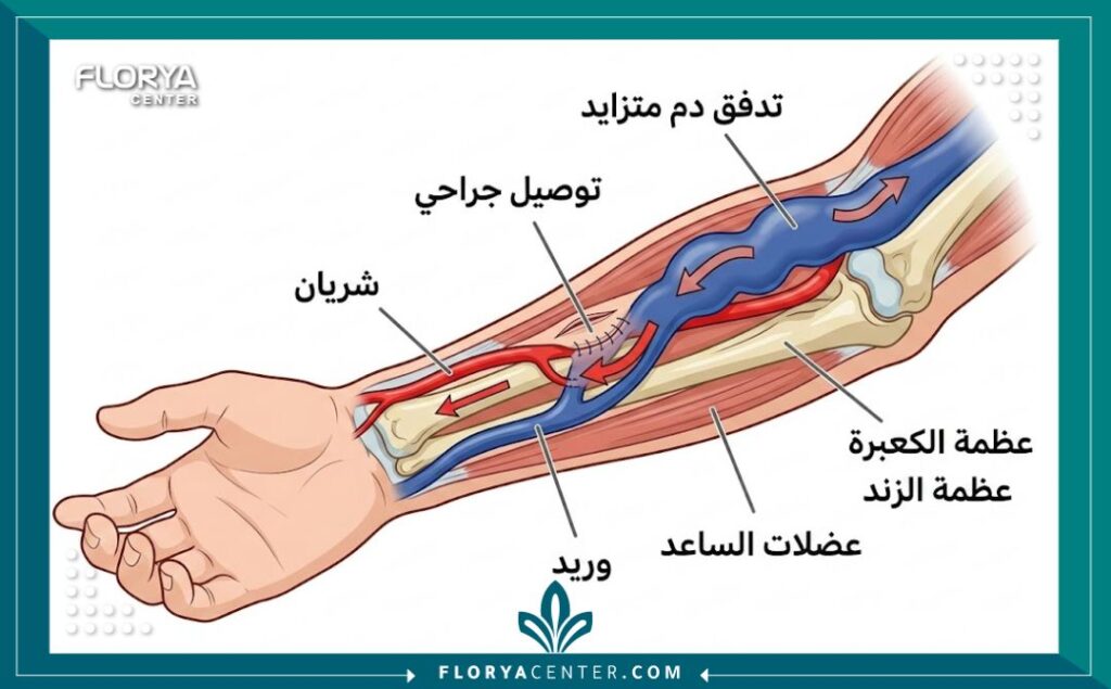 عملية ناسور الغسيل الكلوي (AV Fistula) 2 رسم توضيحي طبي يوضح تشريح ناسور الغسيل الكلوي (AV Fistula) وكيفية توصيل الشريان بالوريد.