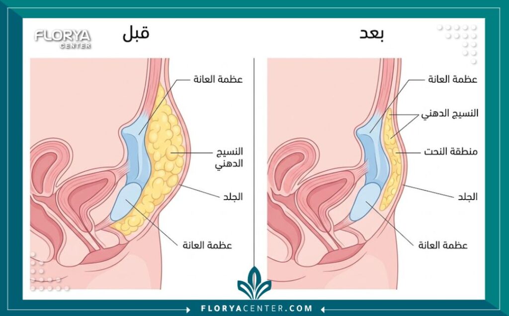 رسم تخطيطي طبي يوضح التشريح قبل وبعد عملية نحت منطقة العانة للنساء.