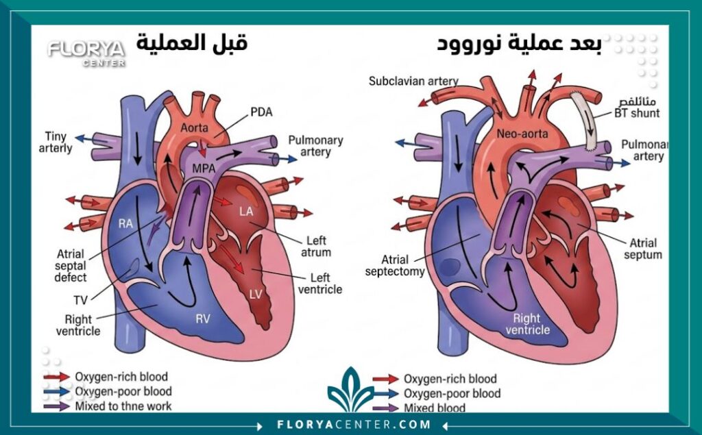 رسم توضيحي طبي يقارن بين شكل القلب قبل وبعد إجراء عملية نوروود الجراحية.