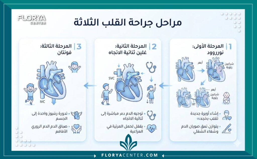 إنفوجرافيك طبي يوضح مراحل علاج متلازمة نقص تنسج القلب الأيسر وعملية نوروود.