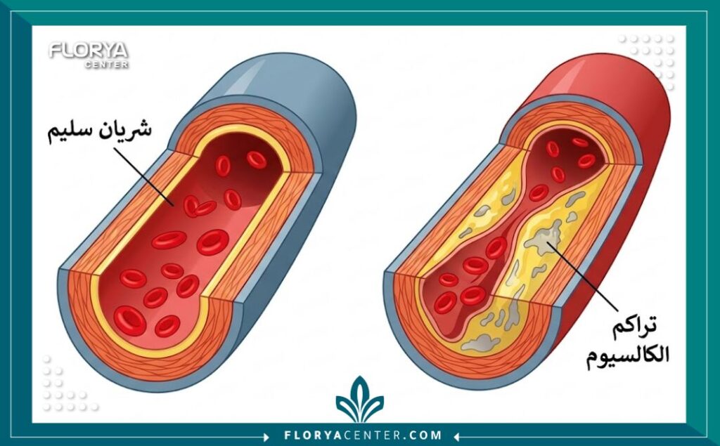 رسم تخطيطي طبي يوضح الفرق بين الشريان السليم وتراكم تكلسات الكالسيوم في جدار الشريان.
