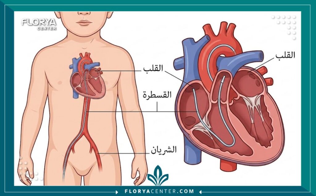 رسم توضيحي طبي يوضح مسار القسطرة داخل قلب الطفل وكيفية إصلاح العيوب الخلقية.