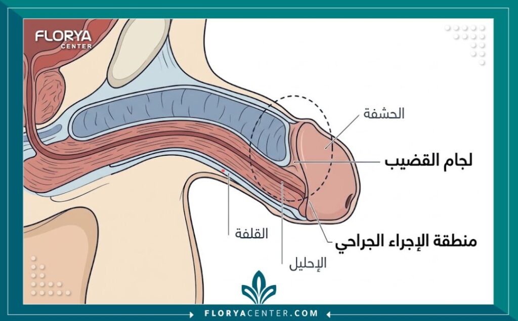 رسم تخطيطي طبي يوضح تشريح لجام القضيب ومكان إجراء عملية الفيمرولوبلاستي.