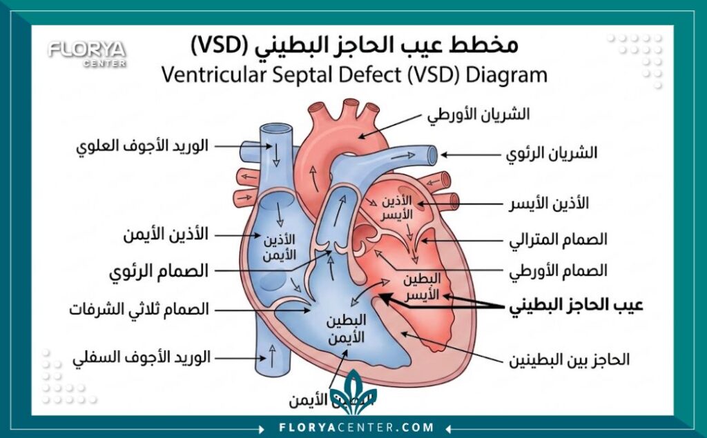 رسم تخطيطي طبي يوضح تشريح القلب وعيب الحاجز البطيني الشائع عند الأطفال مع تسميات باللغة العربية.