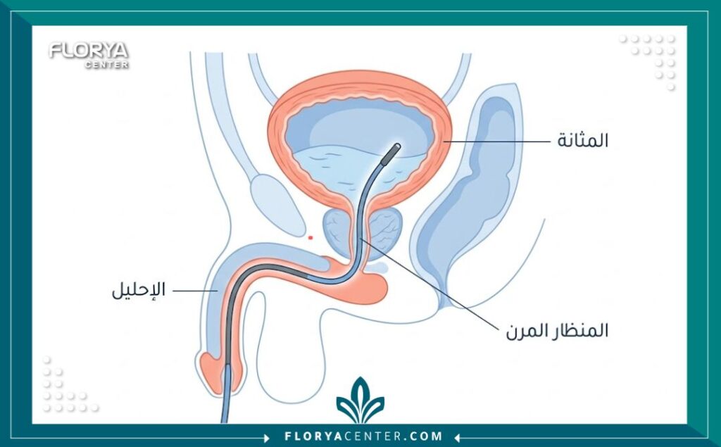 رسم توضيحي يبيّن كيفية دخول منظار المسالك البولية عبر الإحليل لتشخيص أمراض المثانة.
