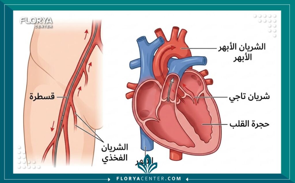 رسم تخطيطي طبي يوضح الفرق بين مسار القسطرة الشريانية وشق العملية المفتوحة في القلب.