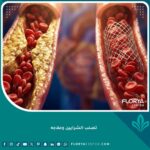 صورة سينمائية مقربة تقارن بين شريان مسدود باللويحات وتدفق دموي سلس بعد وضع الدعامة، تمثل تصلب الشرايين وعلاجه.