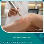طبيب جلدية يعالج الشعيرات الدموية بالليزر في عيادة تجميل في إسطنبول، لقطة مقربة تُظهر دقة الإجراء على الأوردة العنكبوتية.