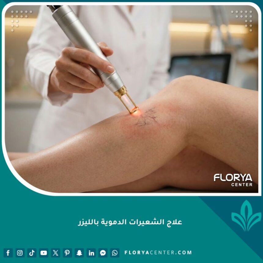 طبيب جلدية يعالج الشعيرات الدموية بالليزر في عيادة تجميل في إسطنبول، لقطة مقربة تُظهر دقة الإجراء على الأوردة العنكبوتية.