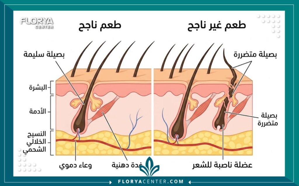 رسم توضيحي طبي يبين الفرق بين غرس البصيلات الصحيح وأحد أسباب فشل عملية زراعة الشعر.