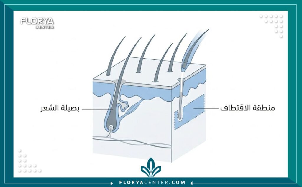 رسم توضيحي طبي يشرح تقنيات اقتطاف وزراعة البصيلات المستخدمة في مراكز تركيا.