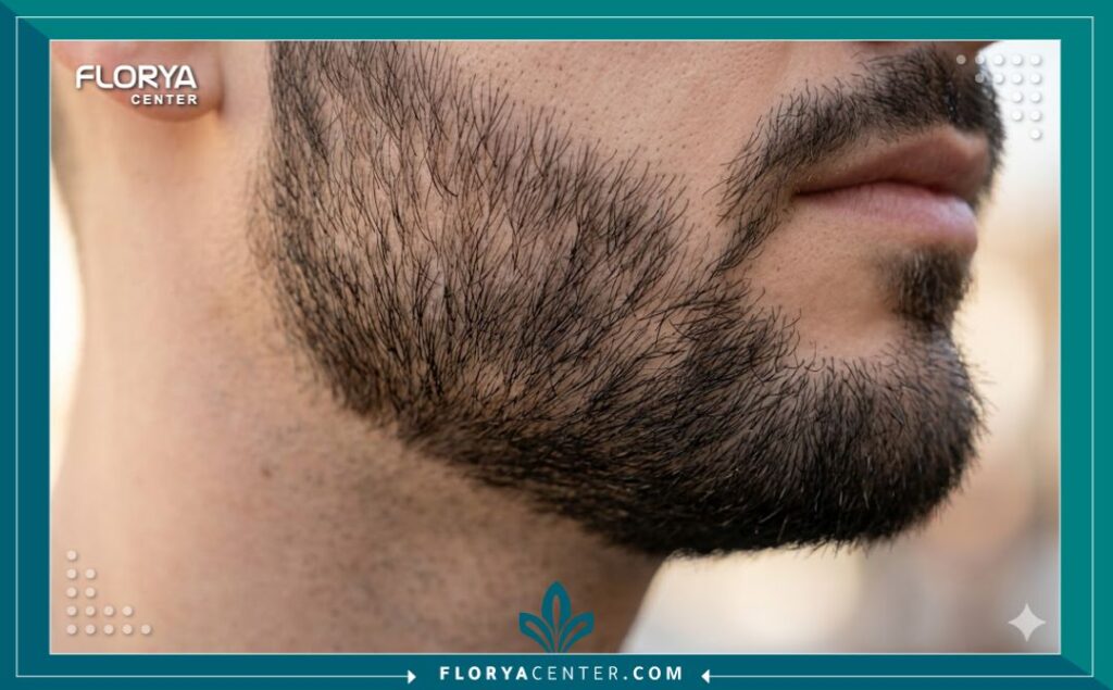 صورة قريبة توضح توزيع الشعر الطبيعي بعد العملية وتفادي مشكلة عدم تناسق اللحية.