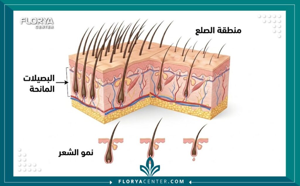 رسم تخطيطي طبي يوضح تشريح بصيلات الشعر والمناطق المانحة والمستقبلة لعملية الزراعة.