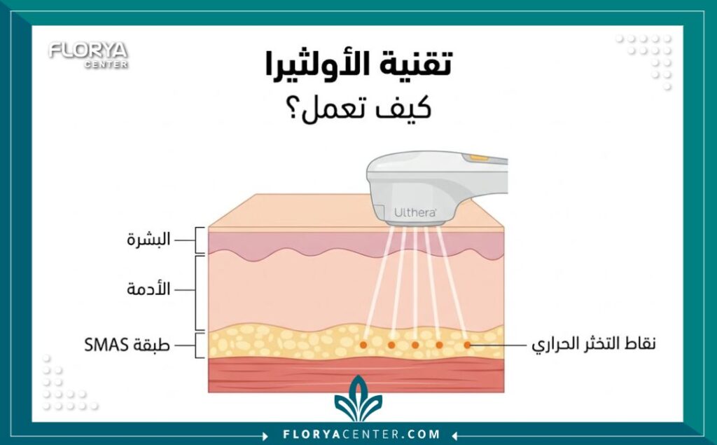 رسم توضيحي طبي يظهر كيفية وصول أمواج الأولثيرا في تركيا يرا فوق الصوتية إلى طبقة SMAS العميقة لشد الوجه.
